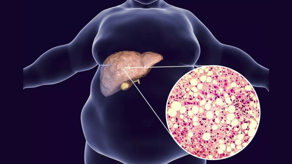 Hígado graso: ¿Qué es y cómo tratarlo?