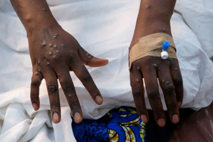 Detectan en Estados Unidos los primeros casos de una variante más grave de la viruela del mono