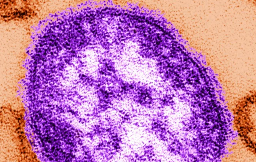 Caso de sarampión en Nebraska confirmado no lejos de Siouxland