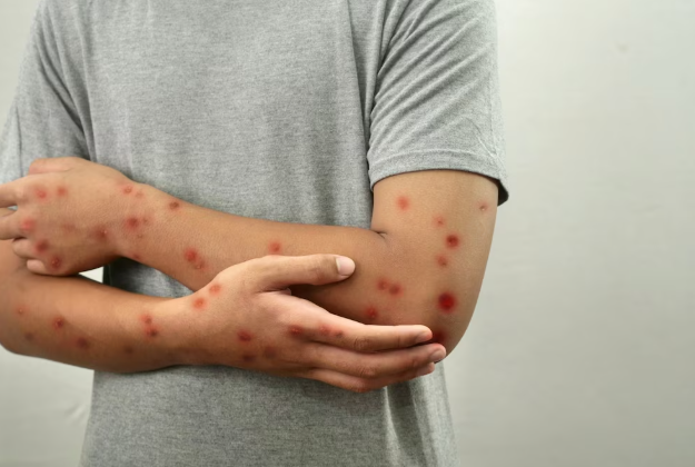 Sarampión en México supera los 9 mil 400 casos: suman 29 defunciones en siete estados